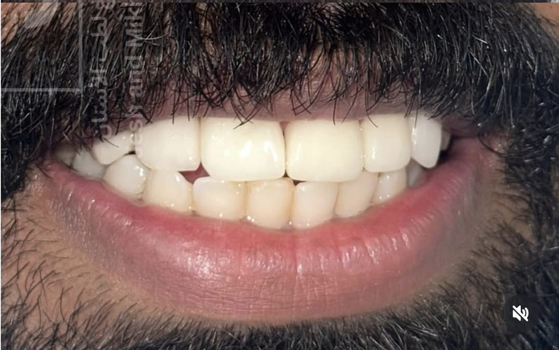 After – Diastema