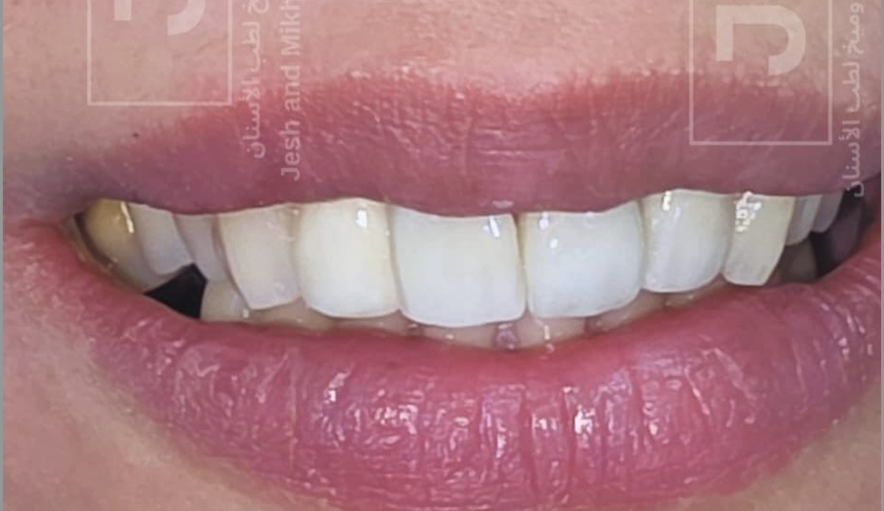 After – Veneers & Crowns