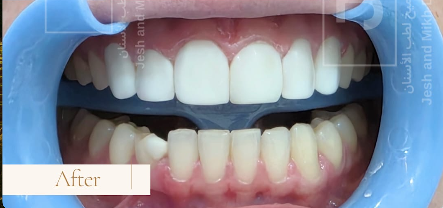 After – Composite Veneers
