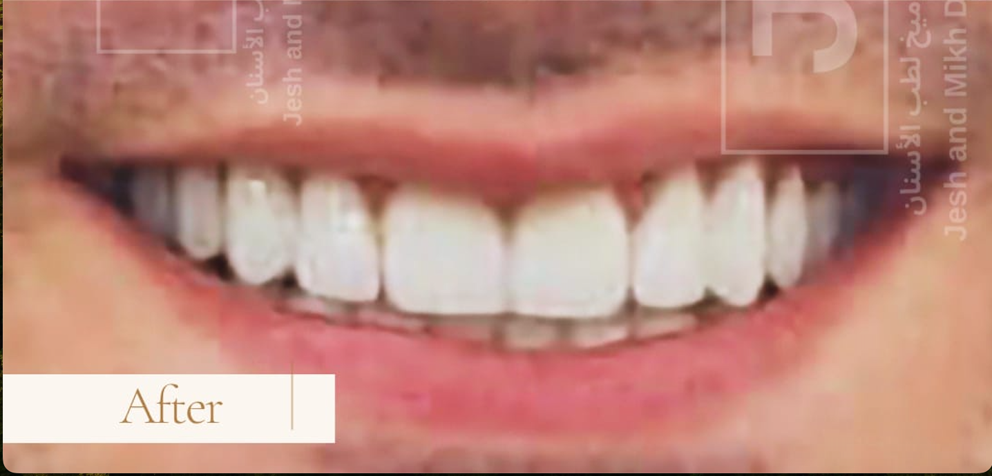 After – Veneers & Crowns