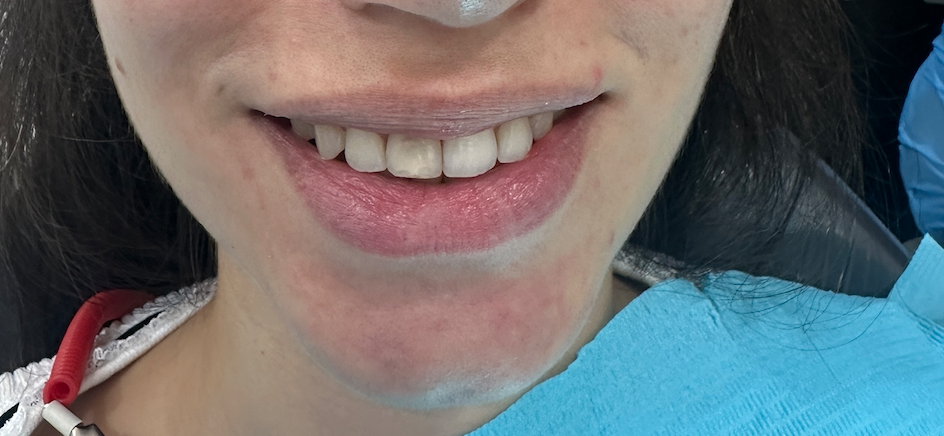 After – Veneers & Crowns