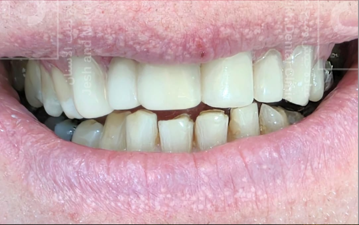 After – Composite Veneers