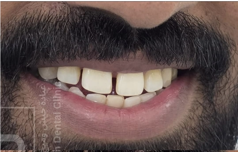 Before – Diastema