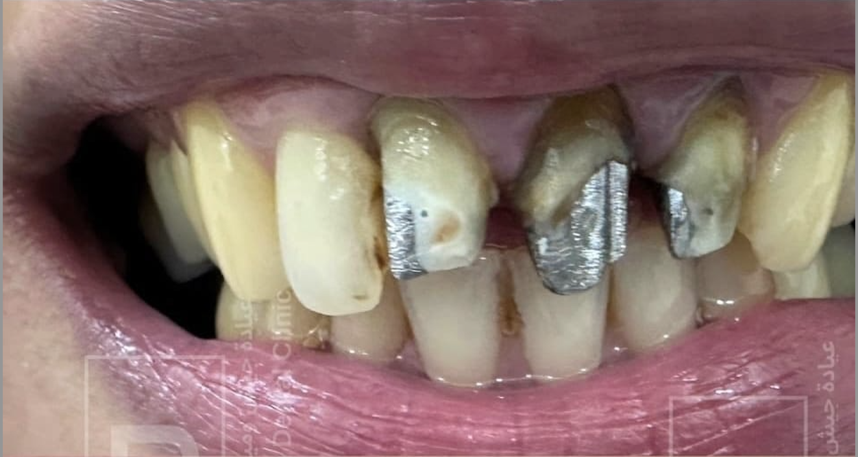 Before – Veneers & Crowns