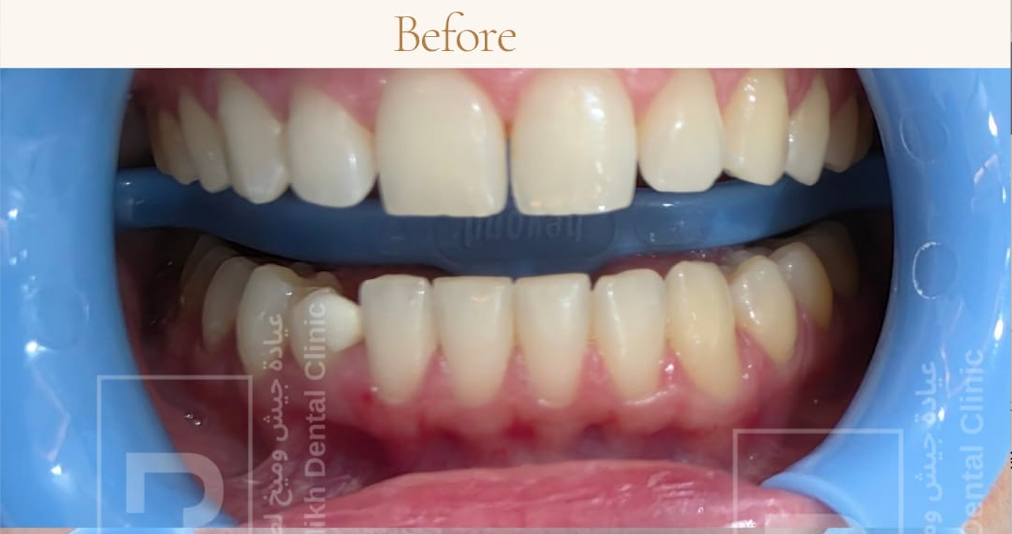 Before – Composite Veneers