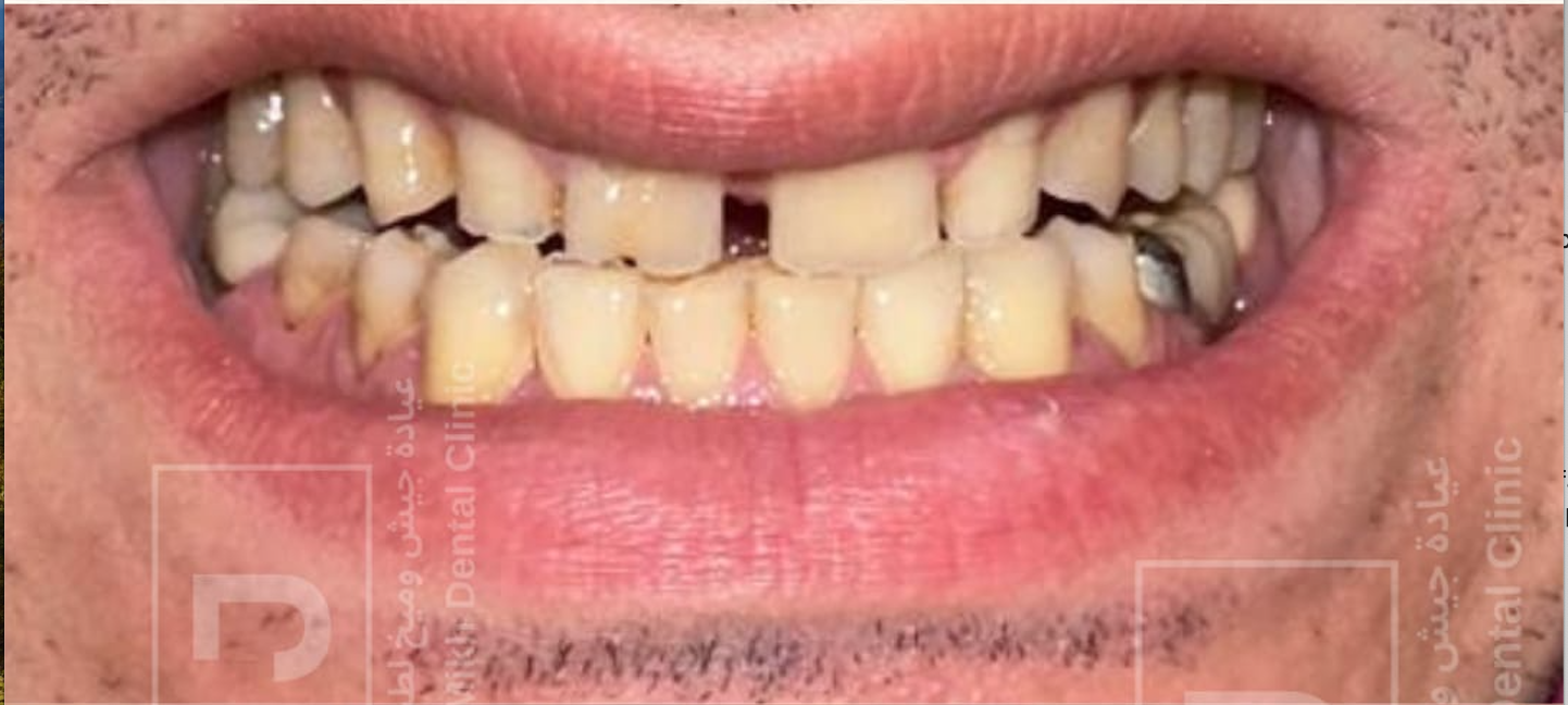 Before – Veneers & Crowns