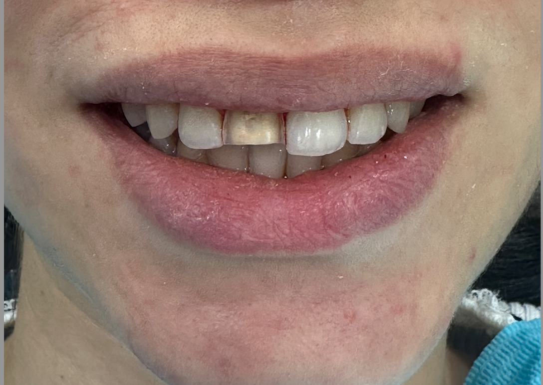 Before – Veneers & Crowns