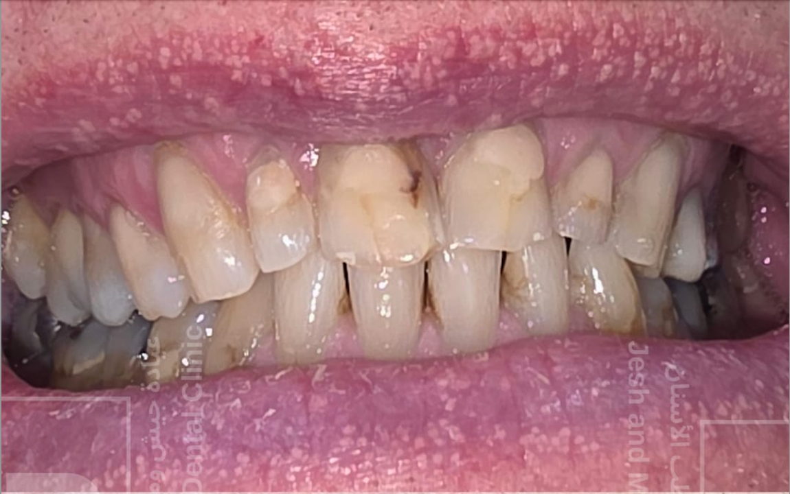 Before – Composite Veneers