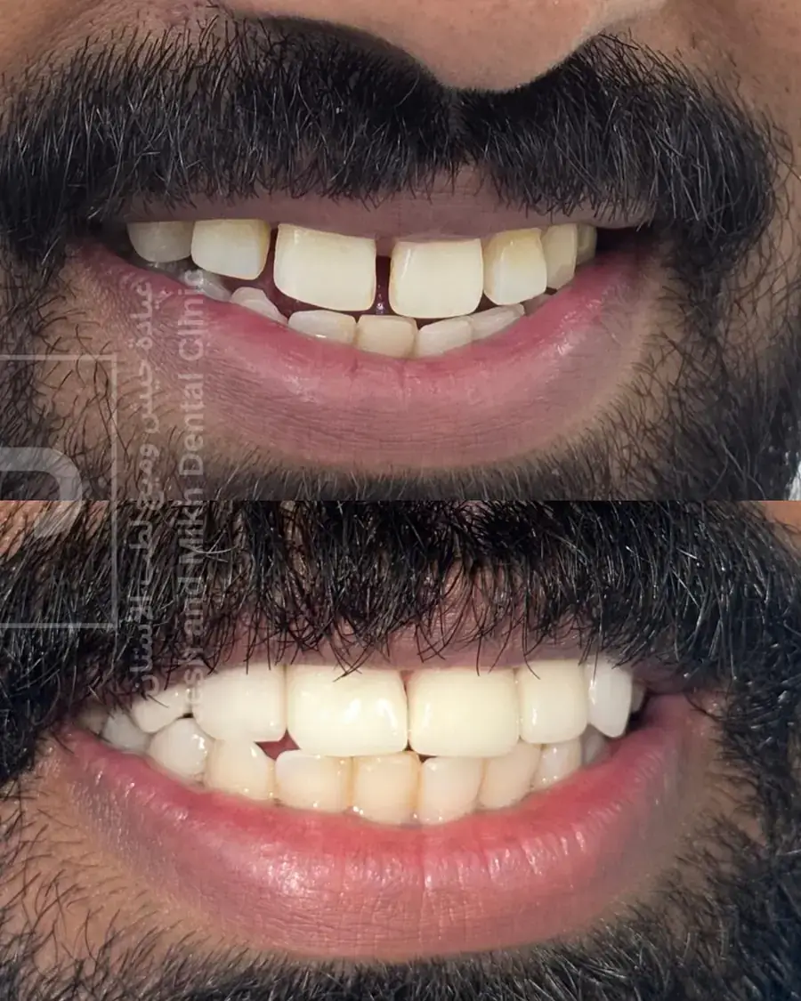 Gap closure: before at the top and after at the bottom