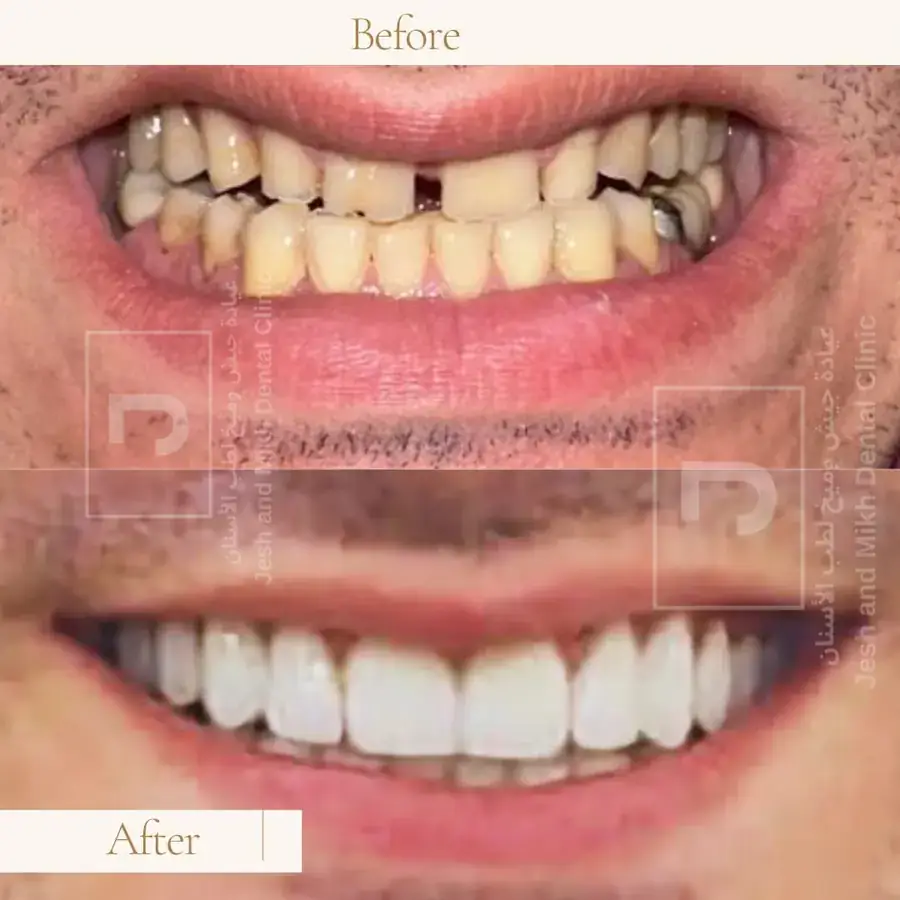 Full Mouth: before at the top and after at the bottom