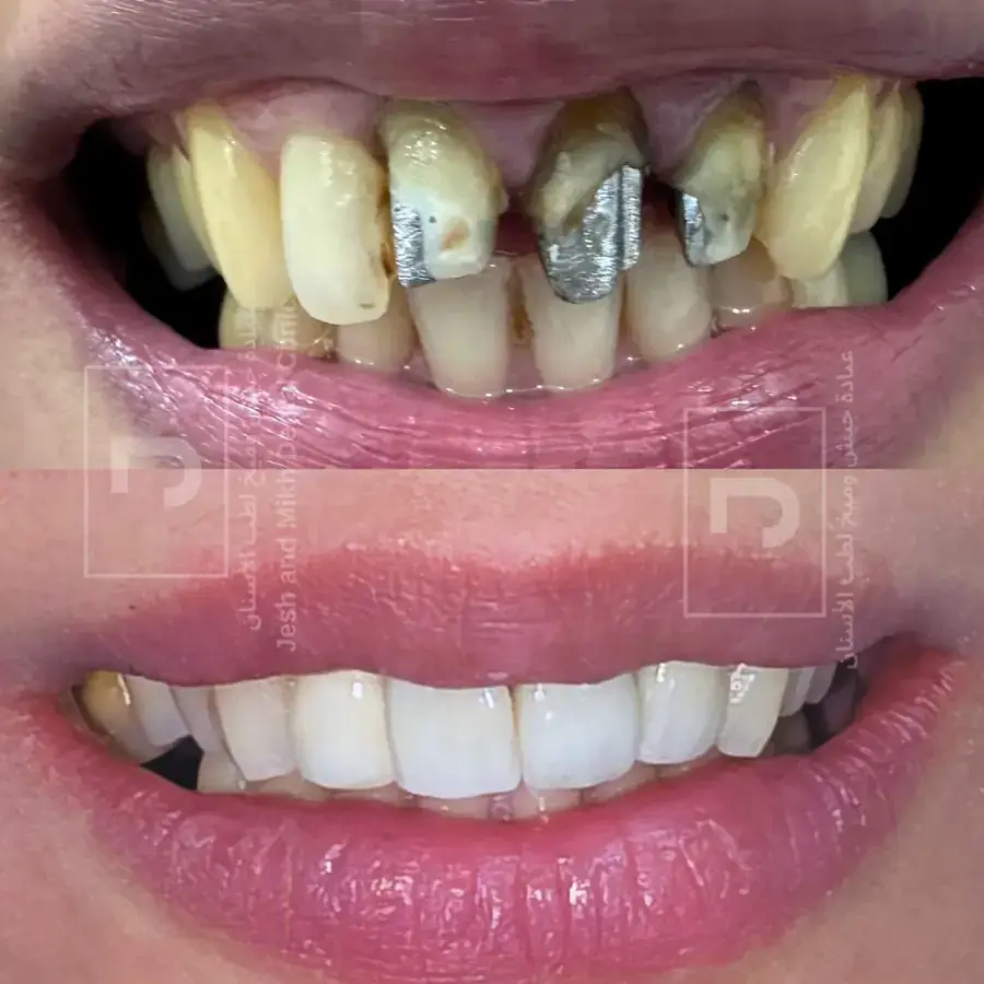 Dental Restoration: before at the top and after at the bottom