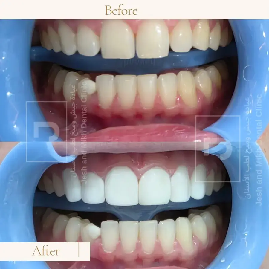 Smile Makeover: before at the top and after at the bottom
