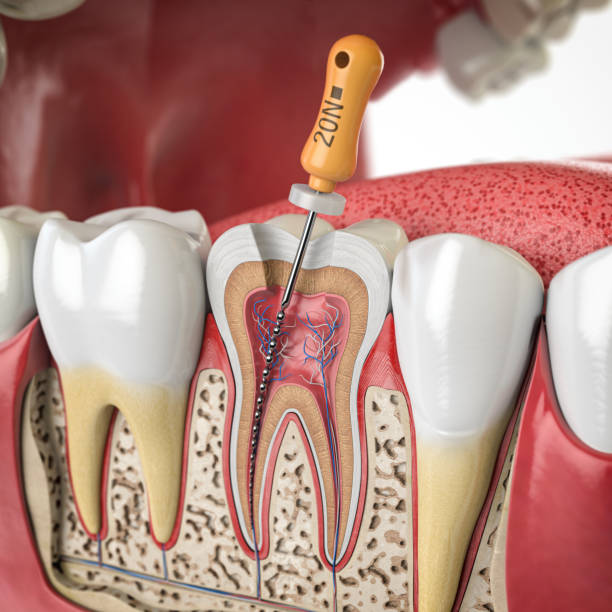 Root Canal Treatment treatment at Jesh and Mikh Dental Clinic
