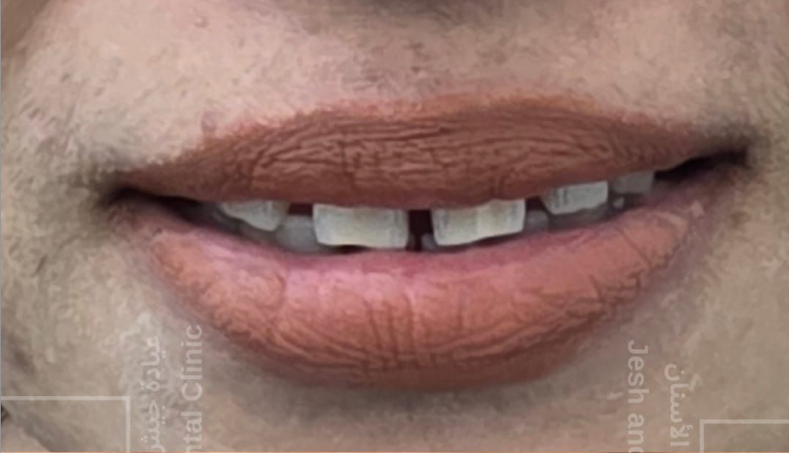 Before Treatment