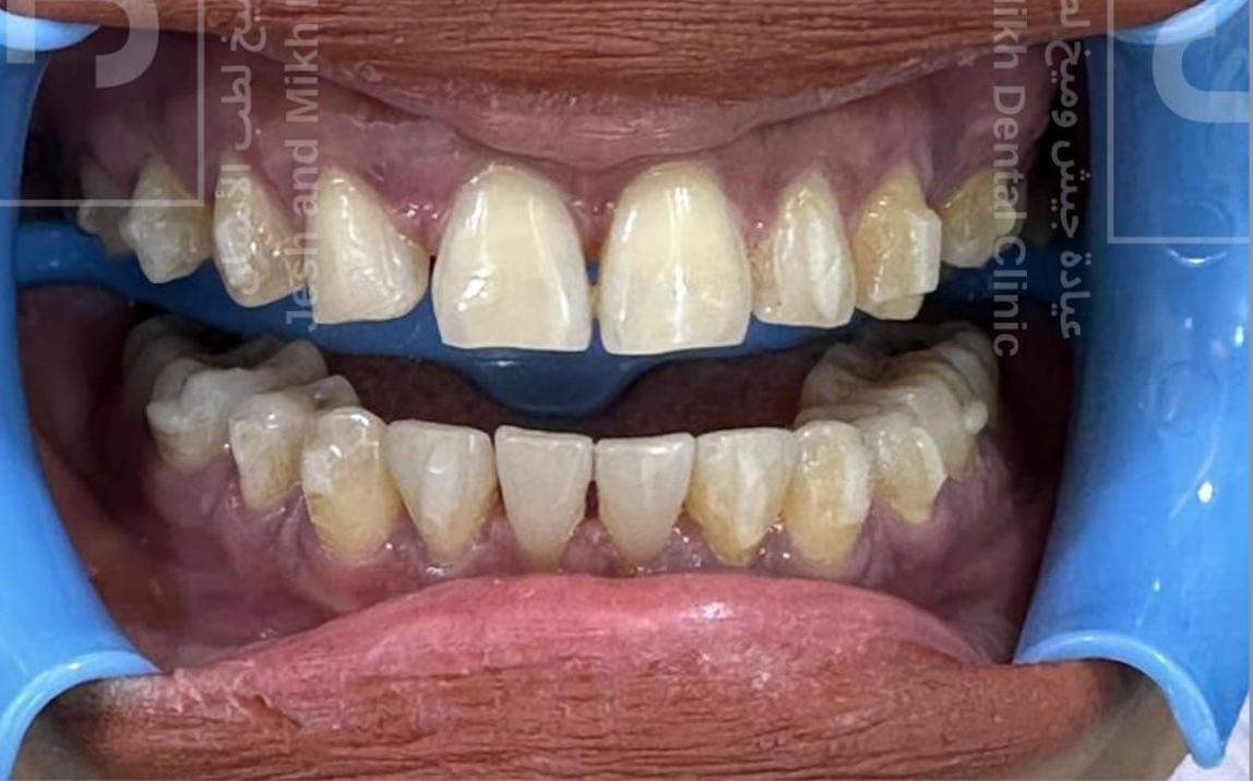 After Treatment