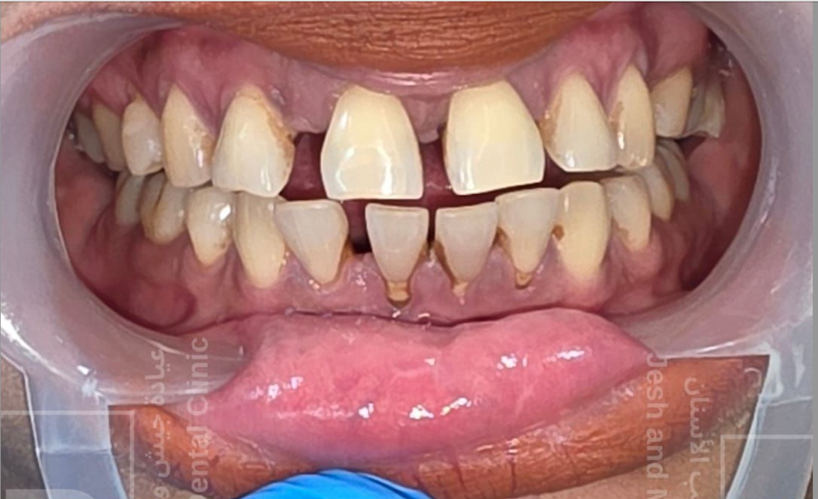 Before Treatment