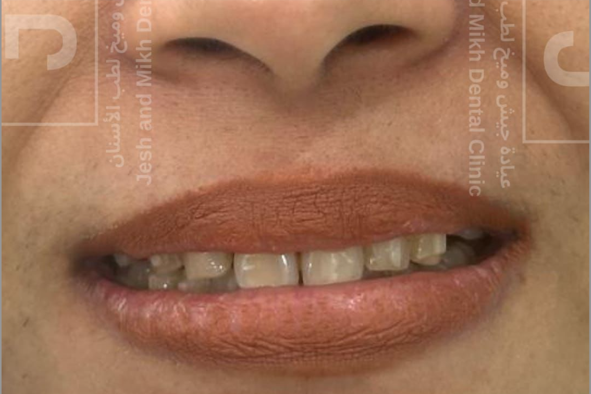 After Treatment