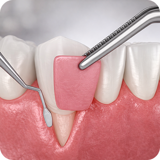 Fluoride Treatment