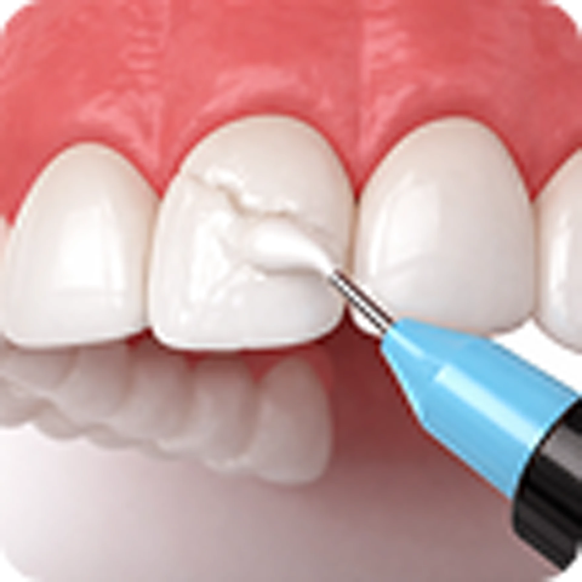 Composite Bonding