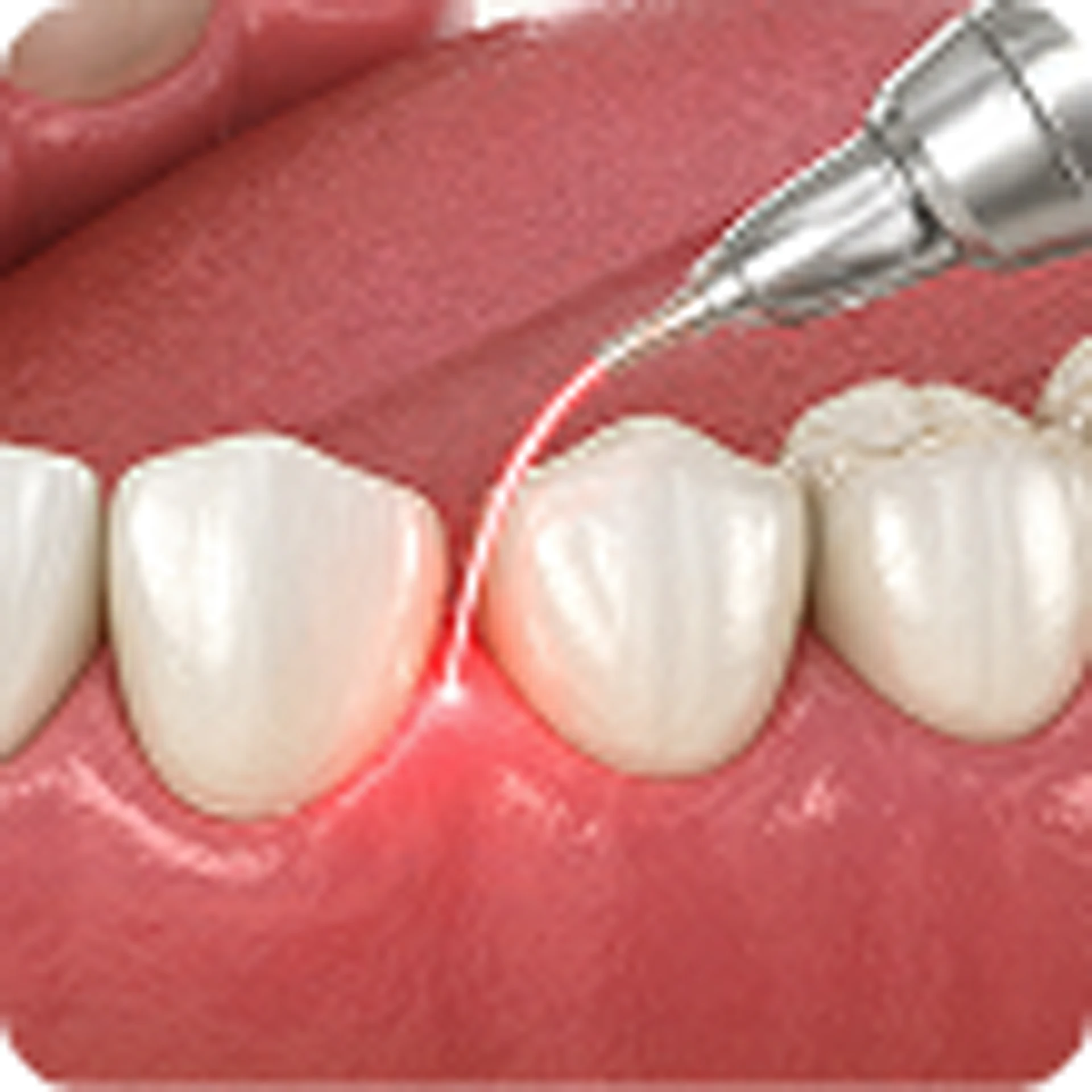 Laser Dentistry