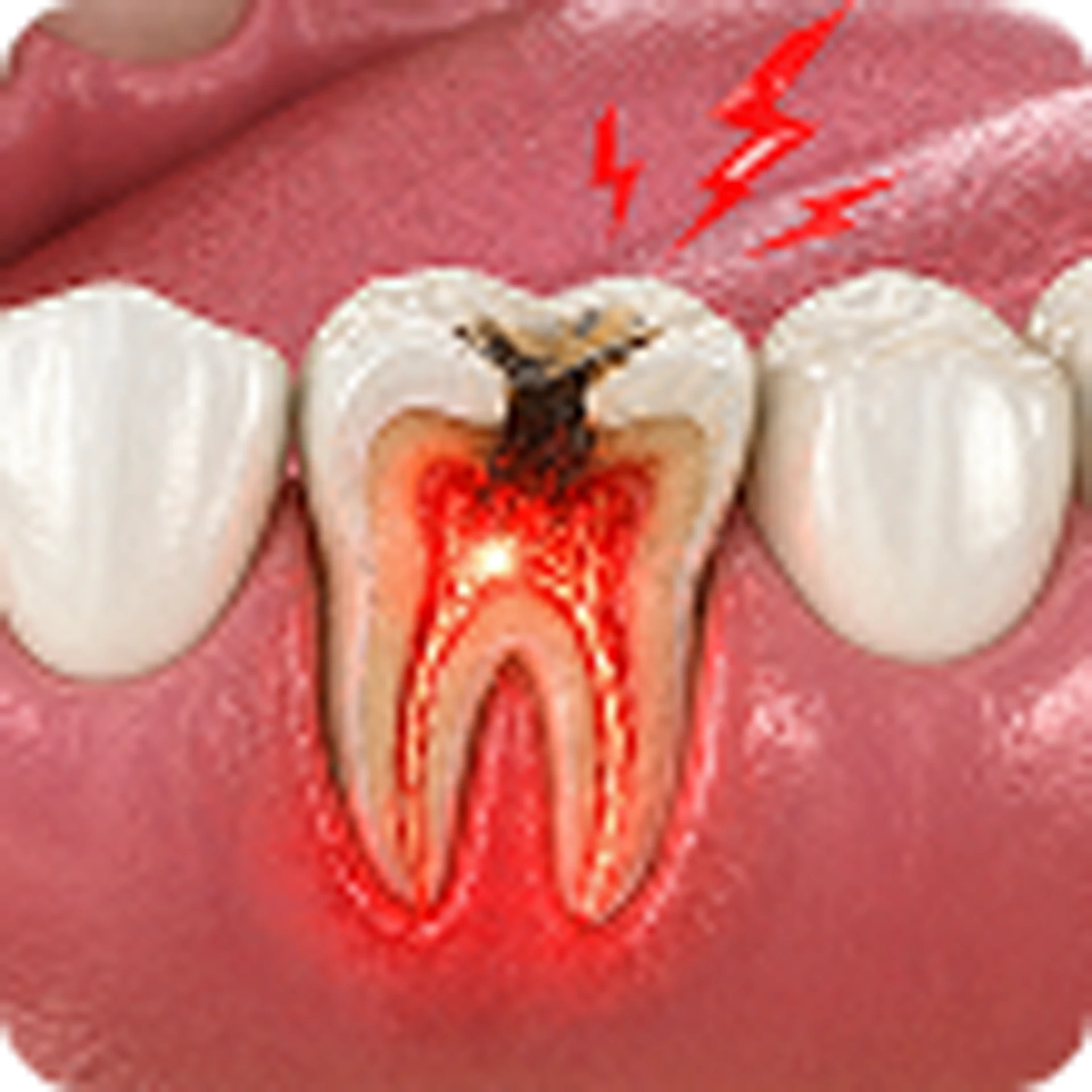 Tooth Pain Treatment