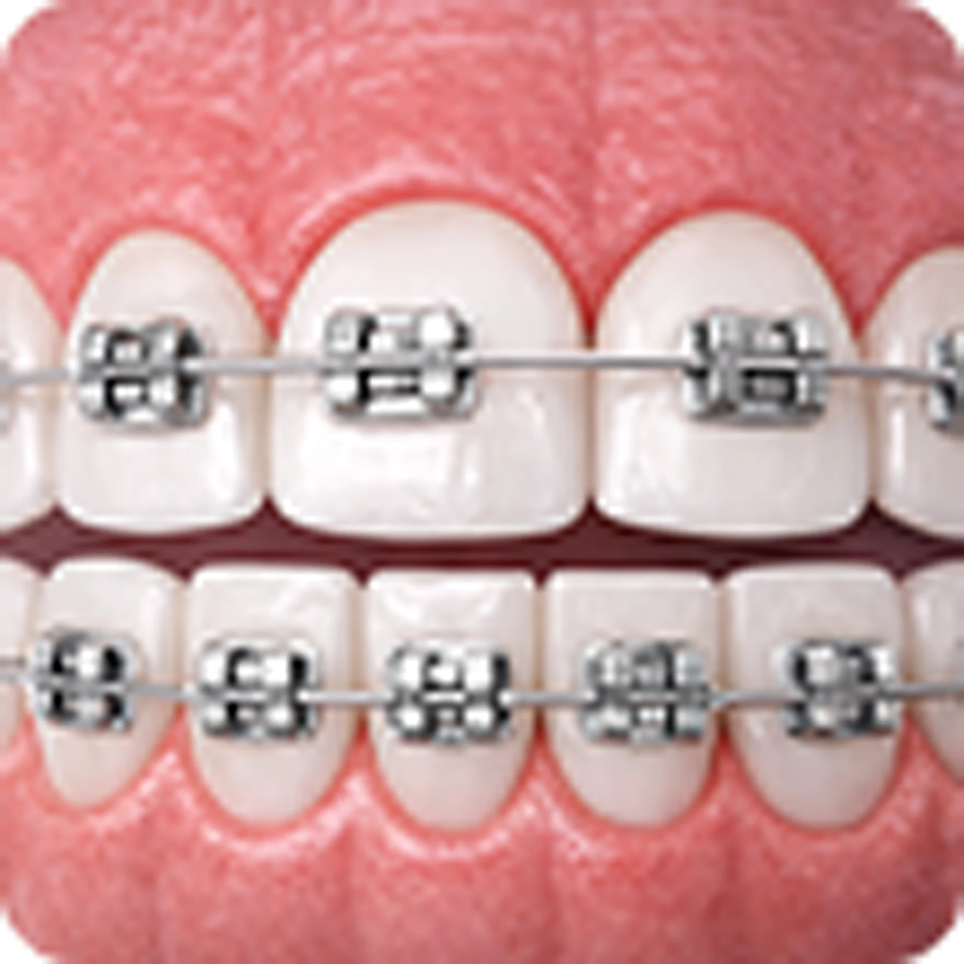 Dental Braces