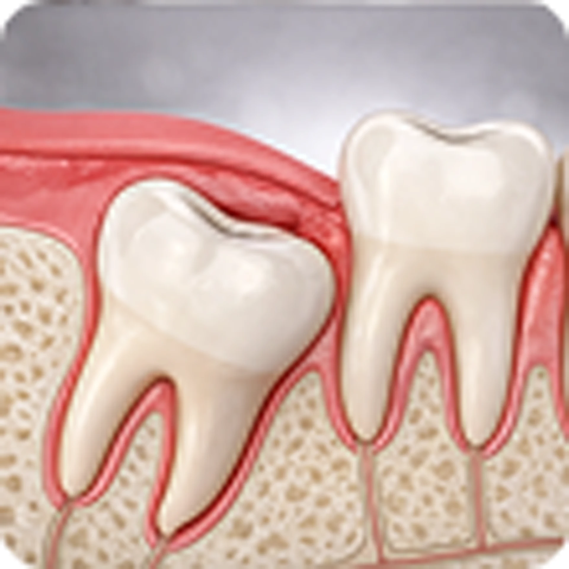 Wisdom Tooth Extraction