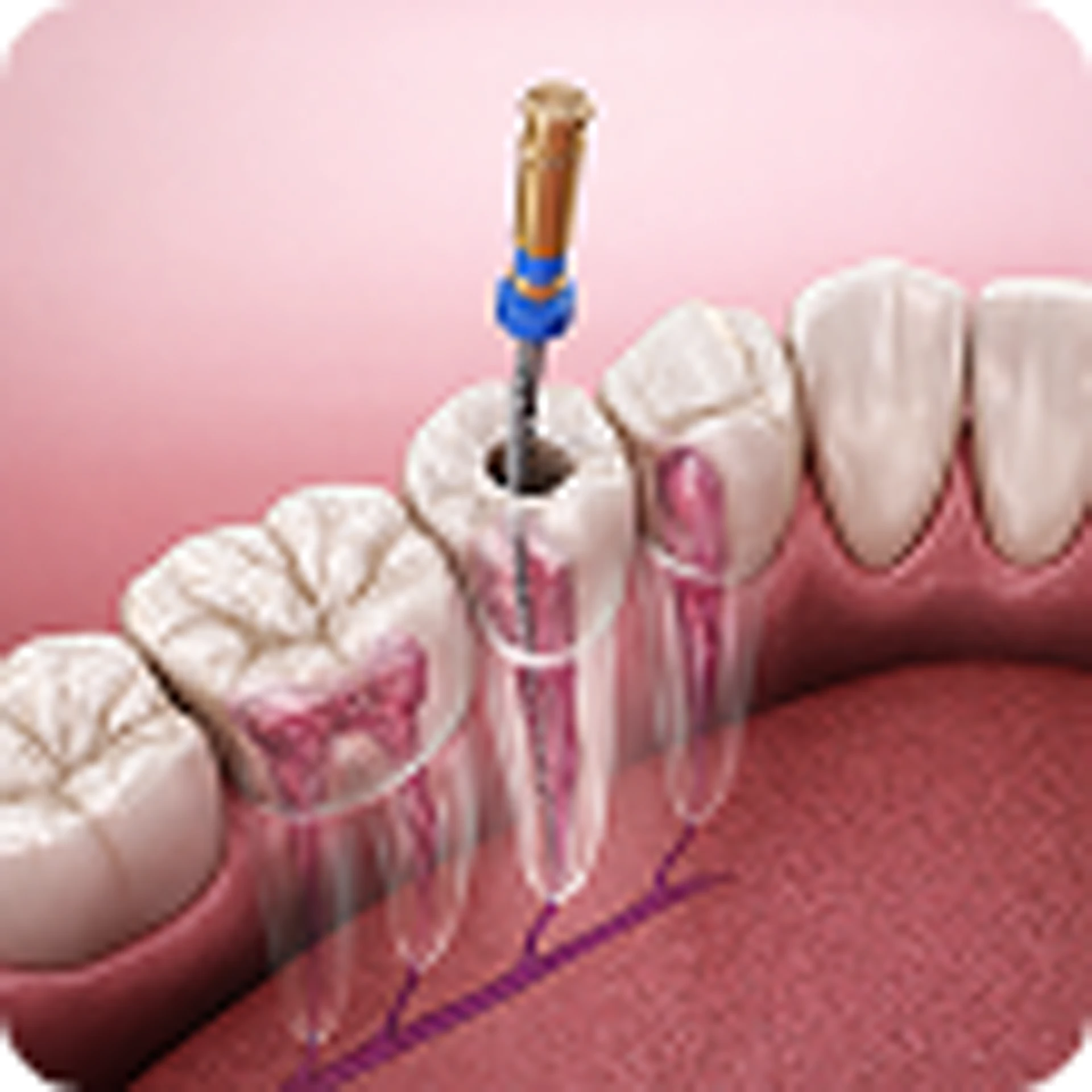 Root Canal Treatment
