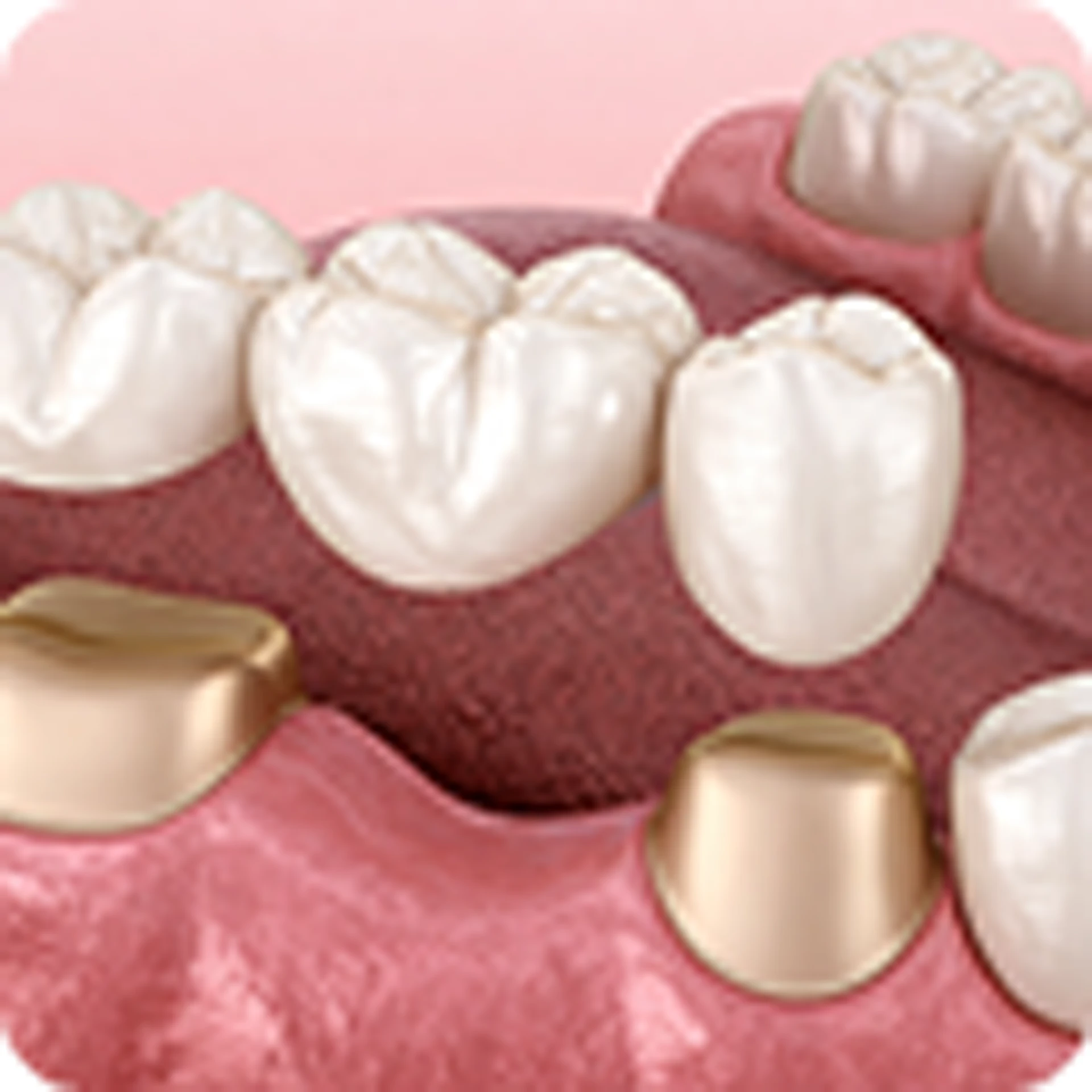 Denture
