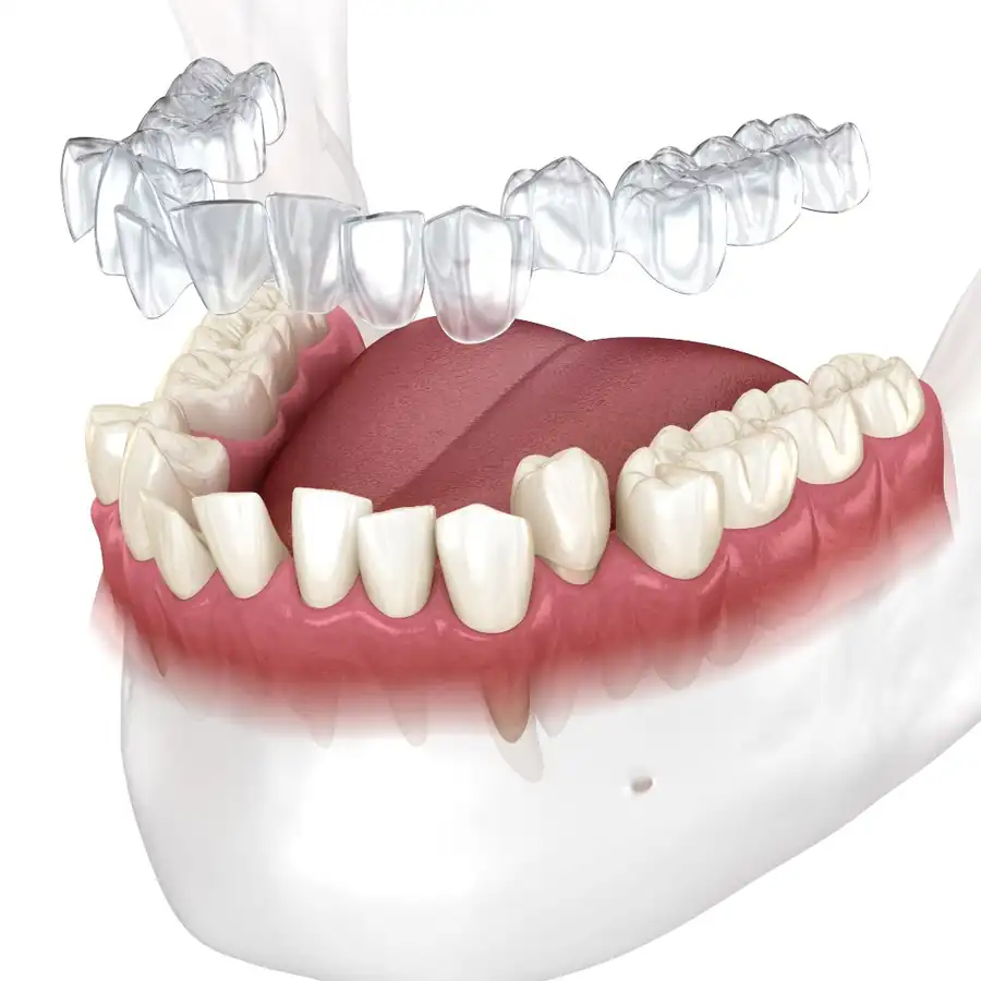 Invisalign