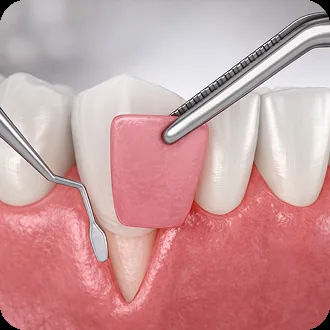 Fluoride Treatment
