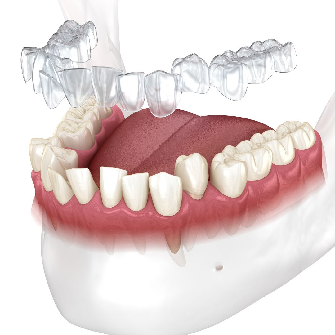 Invisalign