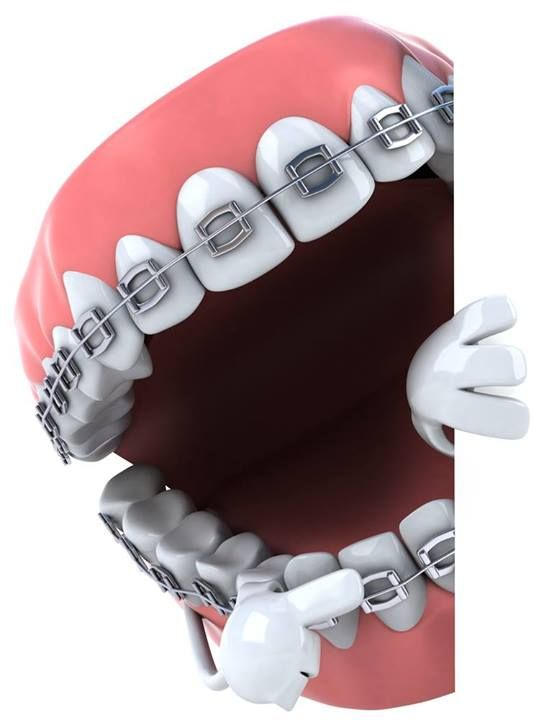 Metal Braces
