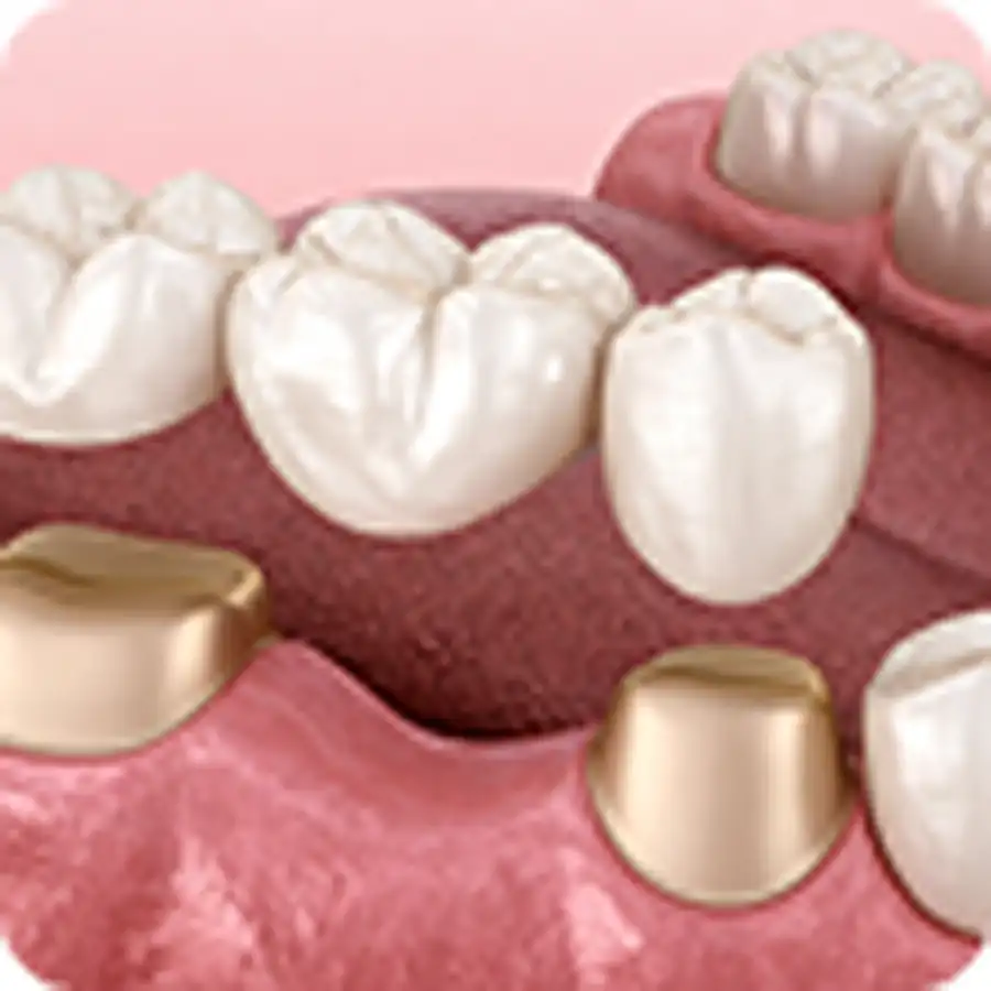 Dental Crowns & Bridges